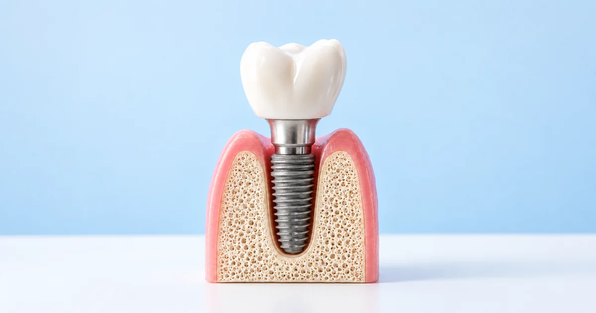 Diş implantı ve kuronun kesit modeli / Cutaway model of a dental implant and crown